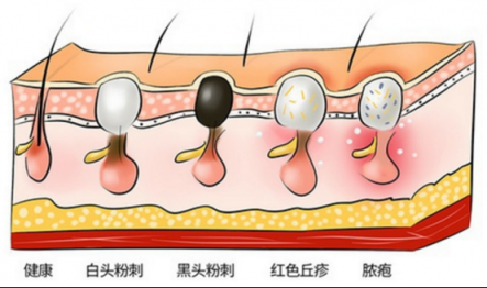 讓黑頭乖乖跑出來，黑頭儀有用嗎？