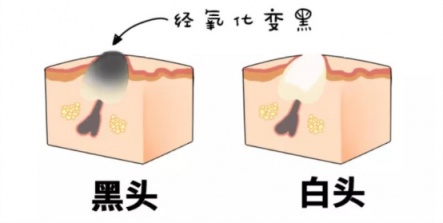 黑頭儀有用嗎？實力派去黑頭就選它！