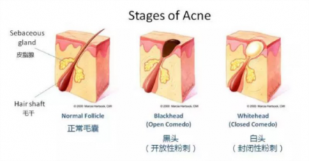 黑頭儀有用嗎？用了它終于擺脫了頑固黑頭！