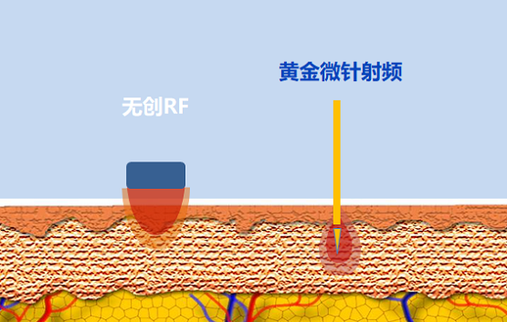 抗衰選熱瑪吉還是黃金微針？看老司機(jī)全面解讀！