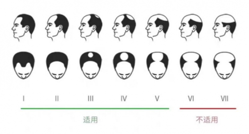 小米眾籌銷量驚人的可思美激光生發(fā)帽，真的能生發(fā)嗎？