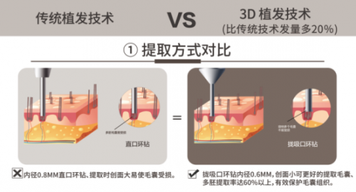 脫發(fā)呈現(xiàn)低齡化趨勢，常州新生植發(fā)：3D植發(fā)成為治脫有力手段