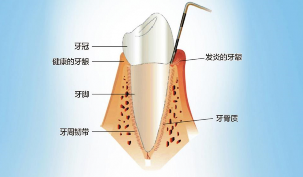 牙縫變大、總?cè)?，警惕“牙周病?/></p><p><strong>牙周病發(fā)病隱匿，早期一般無(wú)癥狀</strong></p><p>李永劍院長(zhǎng)介紹，牙周病是指發(fā)生在牙周組織的疾病，包括牙齦組織的牙齦病和波及深層牙周組織(牙周膜、牙槽骨、牙骨質(zhì))的牙周炎兩大類。牙周疾病是常見(jiàn)的口腔疾病，也是引起成年人牙齒喪失的首要原因。</p><p>“牙周病與齲齒不同，它起病隱匿，初期不會(huì)疼痛，早期僅有出血等輕微癥狀，且病程長(zhǎng)，可達(dá)數(shù)年之久，因此很容易被忽視。” 李永劍院長(zhǎng)表示，牙周病的早期癥狀是刷牙和咬硬物出血，如果在這個(gè)階段進(jìn)行積極治療，效果好，花費(fèi)少。如果等到出現(xiàn)疼痛、腫脹、牙齒松動(dòng)、脫落或咀嚼功能障礙時(shí)，已錯(cuò)過(guò)最佳治療時(shí)機(jī)，不僅治療難度加大，治療費(fèi)用增加，而且無(wú)法恢復(fù)到原來(lái)的健康水平。</p><p align=