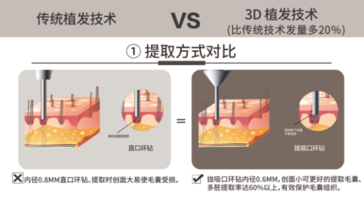 女性植發(fā)消費崛起，武漢新生植發(fā)3D植發(fā)高性價比受歡迎