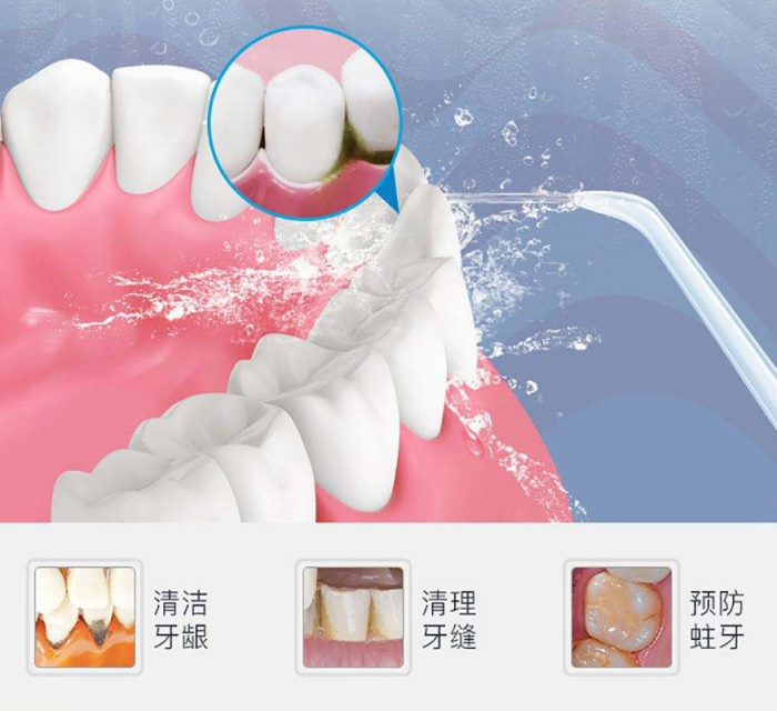 預(yù)防牙結(jié)石 XWAVES小蠻腰SE保衛(wèi)口腔健康